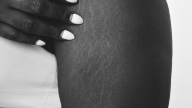 Signs, Causes & 5 Ways To Get Rid Stretch Marks