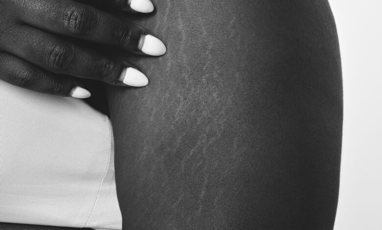 Signs, Causes & 5 Ways To Get Rid Stretch Marks